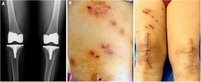 Case report: Be alert to herpes zoster after total knee arthroplasty